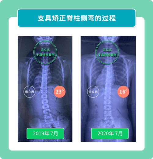 宋立志脊柱侧弯工作室支具矫形案例
