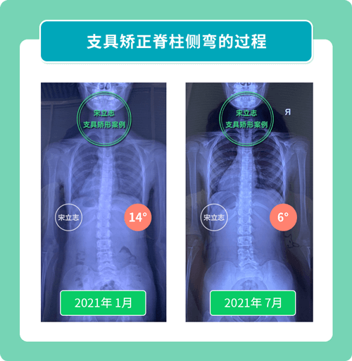 宋立志脊柱侧弯工作室支具矫形案例