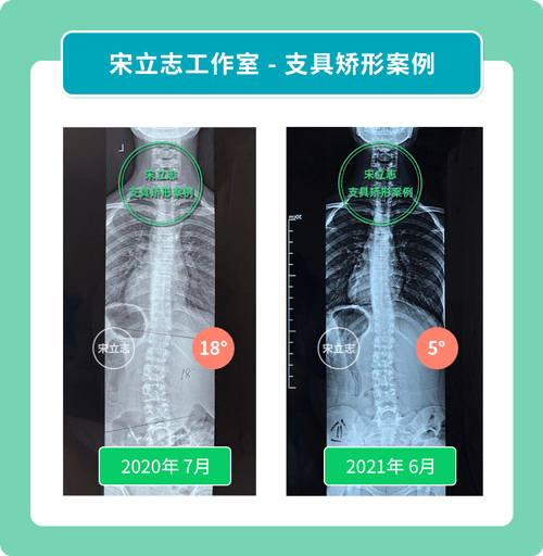 宋立志脊柱侧弯工作室支具矫形案例